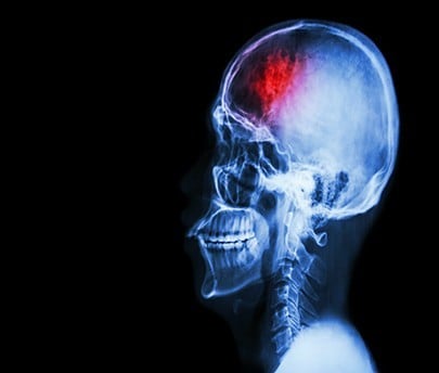 Mechanical Thrombectomy for Acute Ischaemic Stroke in the UAE